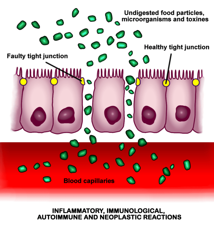 Increased_intestinal_permeability